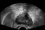 Prostate Biopsy Guidance